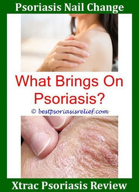 Psoriasis Symptoms And Causes With Images Psoriasis Symptoms
