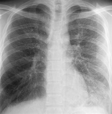 Acute Eosinophilic Pneumonia Cancer Therapy Advisor