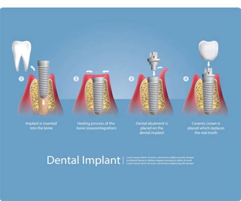 Dental Implants Asia Pacific Dental Centre