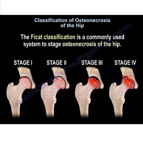 Ficat Classification For Osteonecrosis Of The Hip