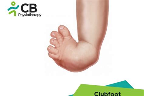 What Is Clubfoot Or Congenital Talipes Equinovarus Or Ctev Symptoms