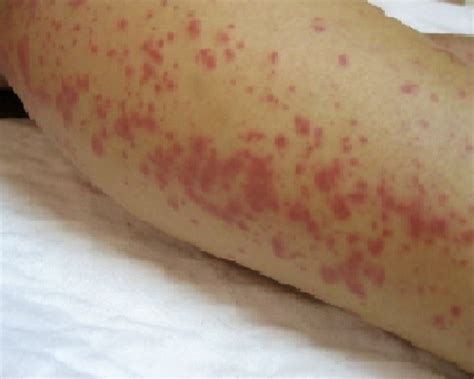 Maculopapular Rash Picturtes Causes Symptoms