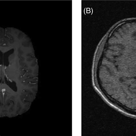 Clinical Brain Magnetic Resonance Imaging Mri From Brats 2013 Database Download Scientific