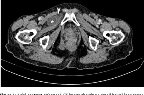 Figure 1 From Small Bowel Obstruction As A Result Of An Obturator