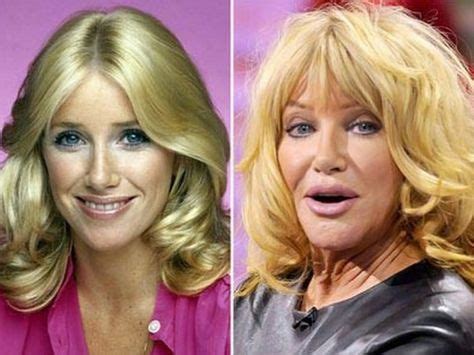 Suzanne Somers The World S Most Expensive Celebrity Plastic Surgeries Bad Celebrity Plastic