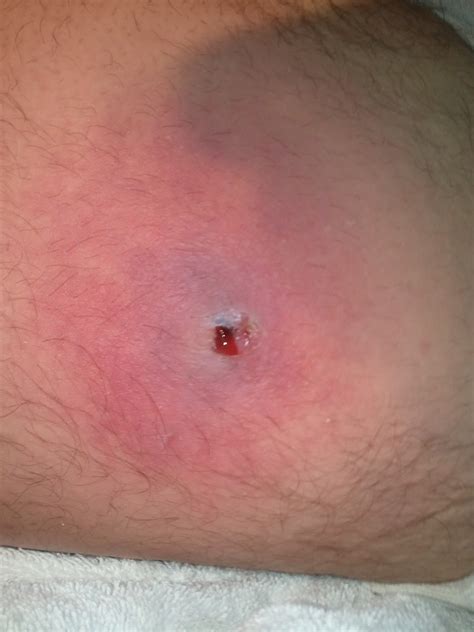 Pictures Of Recluse Spider Bite