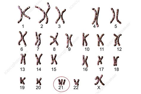 Down S Syndrome Karyotype Illustration Stock Image F