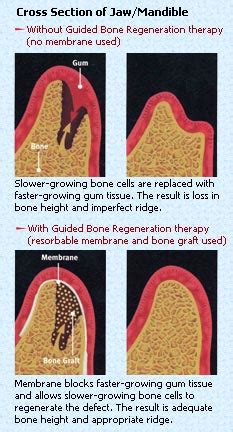 Cross section of bone diagram. Ridge Augmentation | Livingston Periodontal & Implant ...