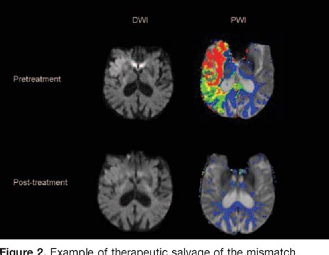 Figure 2 From Evolving Paradigms In Neuroimaging Of The Ischemic