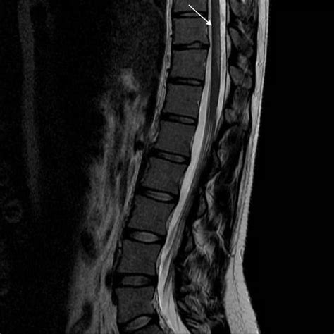 Transverse T2 Weighted Mri Scan Of The Cervical Spinal Cord At The C7
