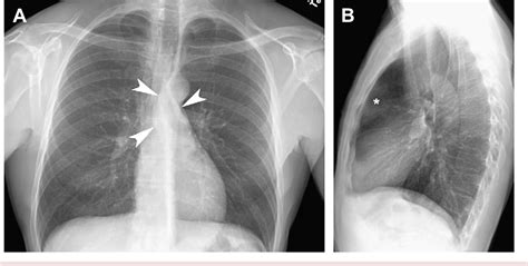 Thymic Epithelial Neoplasms Imaging Practice Essentials Radiography My Xxx Hot Girl