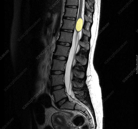 Benign Cyst In The Spine Stock Image M1300867 Science Photo Library