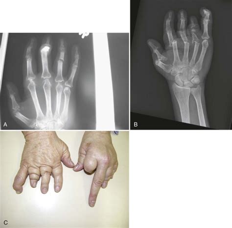 Joint Replacement in the Hand and Wrist: Surgery and Therapy