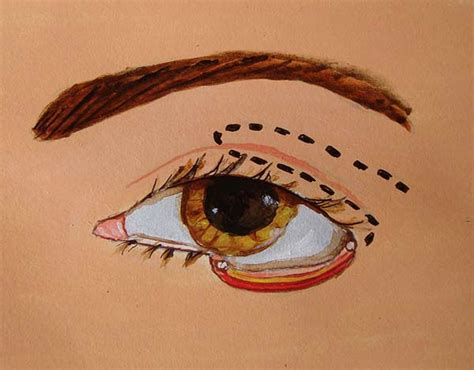 RBCP Reconstruction Of The Lower Eyelid Using A Full Thickness Upper
