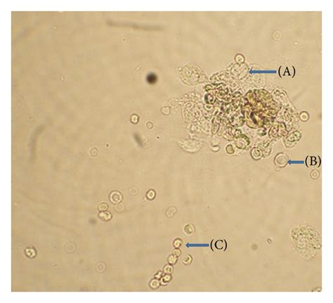 Pus is thick glue tips to treat pus cells in urine: Normal Pus Cells In Urine Microscopy