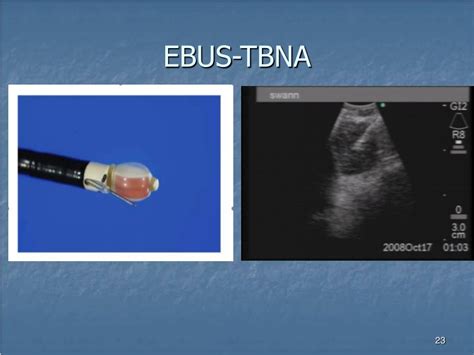 Ppt Endobronchial Ultrasound Guided Transbronchial Needle Aspiration