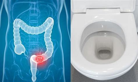 Bowel Cancer Symptoms Signs Of A Tumour In The Toilet Include Blood In