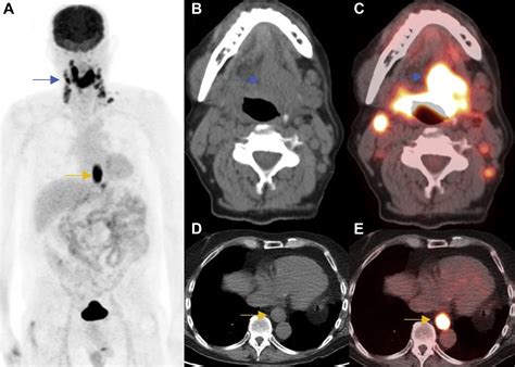 Pet Imaging For Head And Neck Cancers Radiology Key
