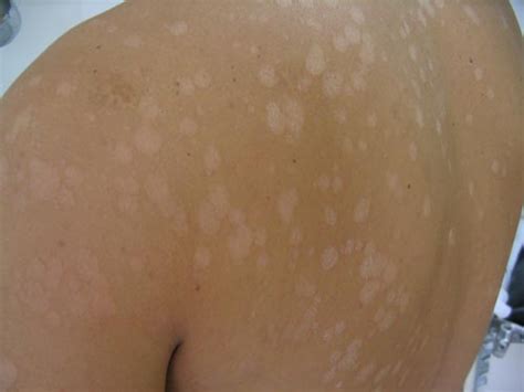 Pitiriasis Versicolor Dermas Skin Piel Información