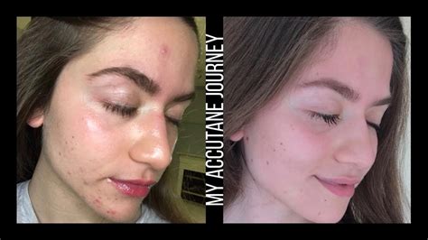 My Accutane Experience How I Got Clear Skin Before And After Pictures
