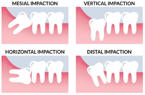Wisdom Tooth Extraction The Dream Smile Dental Clinic
