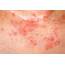 Eczema Vs Psoriasis What You Should Know  ThriveNaija