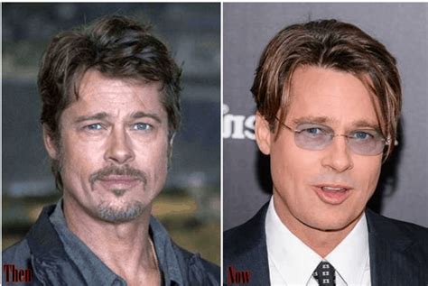 Celebrity Male Plastic Surgery Before And After Photos 016