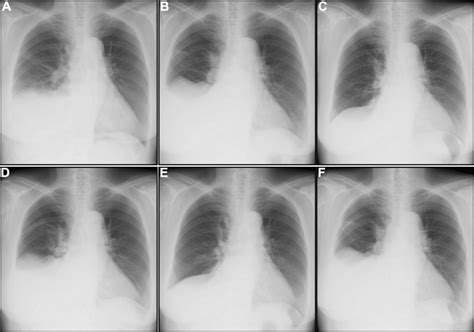 Serial Chest Radiographs A On Admission An Initial Radiograph Shows