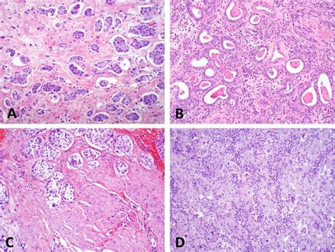 What Is The Significance Of Variant Histology In Urothelial Carcinoma