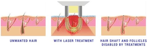 Laser Hair Removal Texas American Laser Med Spa