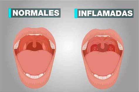 Amígdalas ¿cuál Es Su Función Y Cuándo Hay Que Sacarlas