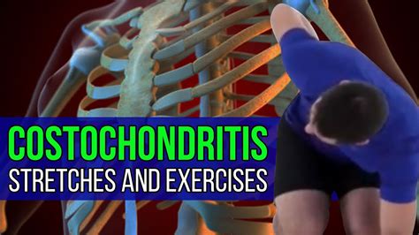 Costochondritis Stretches And Exercises Thoracic And Rib Mobility Youtube