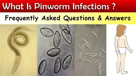 What Is Pinworm Infections Faq And Answers Youtube