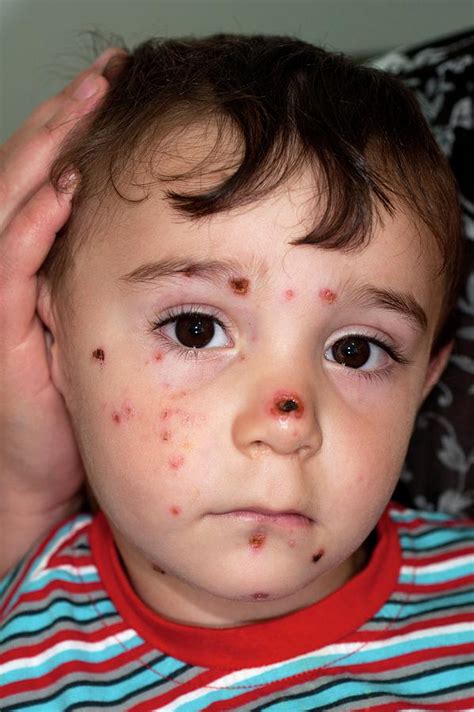 Impetigo Skin Infection In A Child Photograph By Dr Harout Tanielian