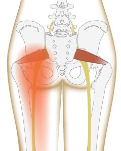A pulled muscle occurs when you tear or overstretch some of the muscle fibers. 3 Types of Pain in the Butt (and What You Can Do About Them) | YogaUOnline