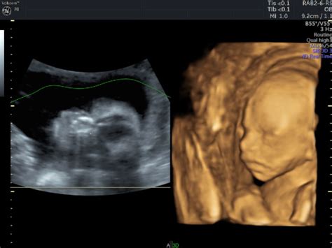 Baby Bonding Scan Private One On One Pregnancy And Fertility Ultrasound