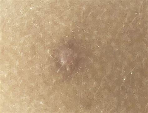 Cryotherapy Skin Tag And Wart Removal In Melbourne