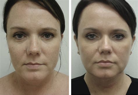 Thermage Skin Tightening By Dermatologists In Crest Hill And Naperville