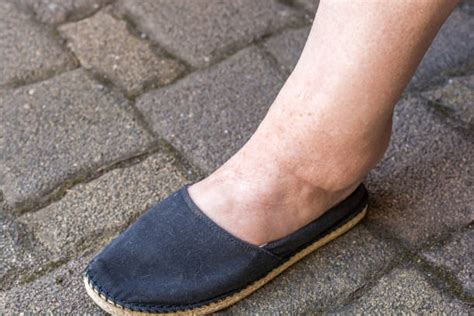 Swollen Heel Stock Photos Pictures And Royalty Free Images Istock