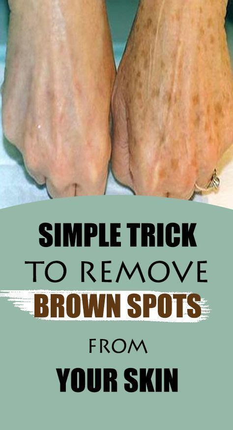 Homemade Remedy For Age Spots And Wrinkles In 2020 Spots On Face Brown Spots On Face Brown