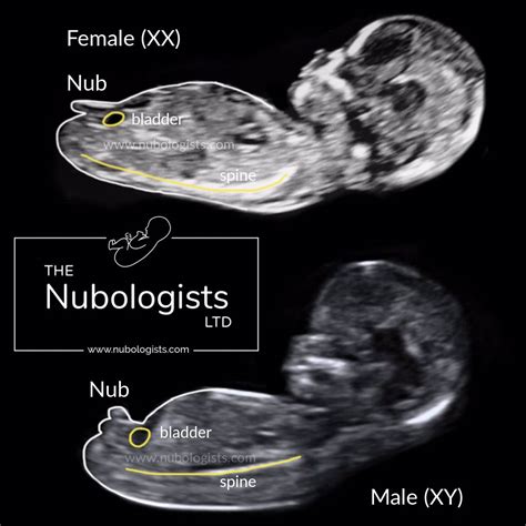 The Nub Theory Nub Theory Ultrasound Gender Prediction Gender Prediction