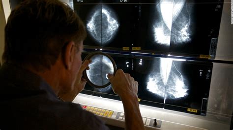 Dont Postpone Mammograms Because Of Swollen Lymph Nodes After Covid 19