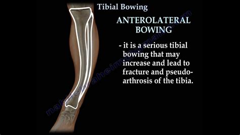 Tibial Bowing Everything You Need To Know Dr Nabil Ebraheim Youtube