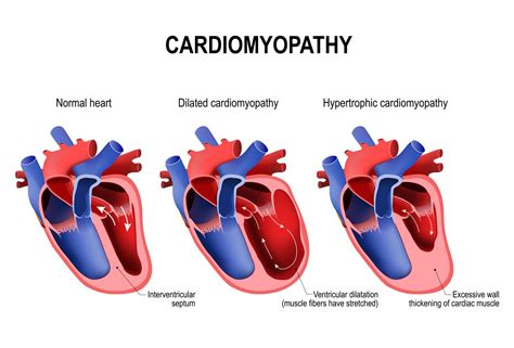 Cardiomyopathy Definition Causes Symptoms And Treatment