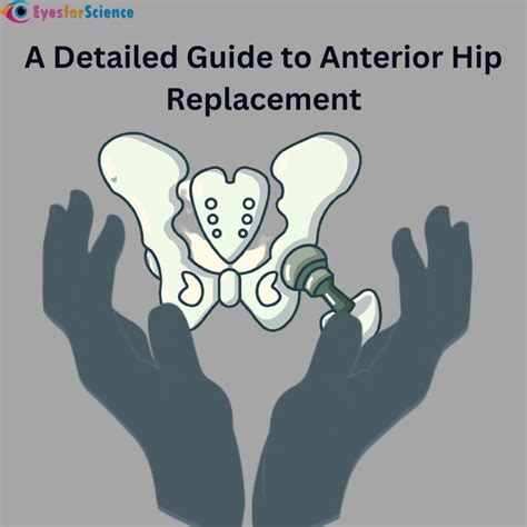 Anterior Hip Replacement A Detailed Guide
