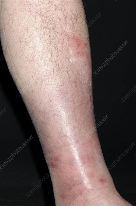 Infected Lymphoedema Stock Image M2000251 Science Photo Library