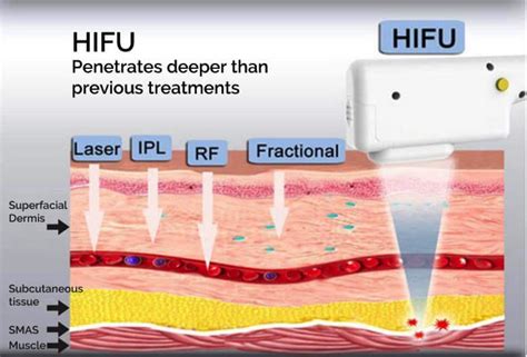 Hifu Facial Treatment Collagen Stimulation Luna Clinic