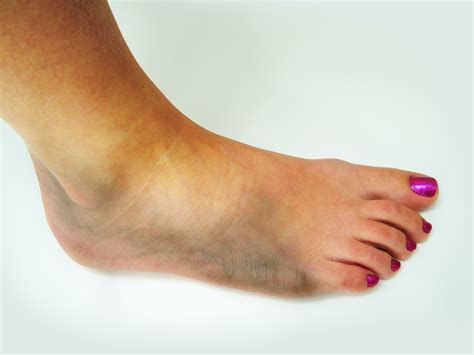 Bruised Foot Symptoms
