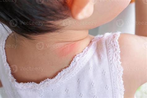 Baby Skin Rash And Allergy With Red Spot Cause By Mosquito Bite At Neck