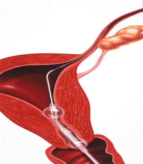 Blocked Fallopian Tubes Here S How We Can Help